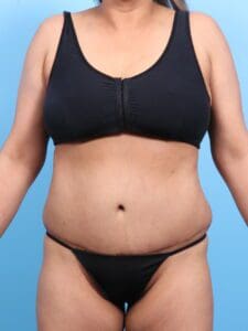Tummy Tuck - Case 1829 - After
