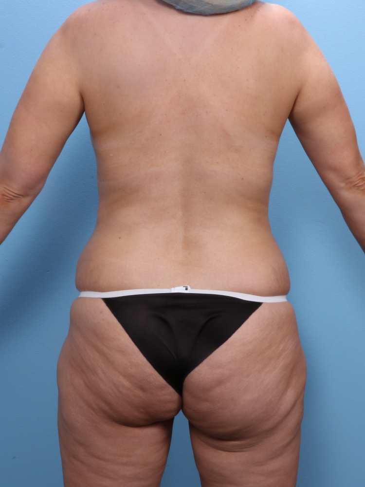 Tummy Tuck Patient Photo - Case 1848 - before view-1