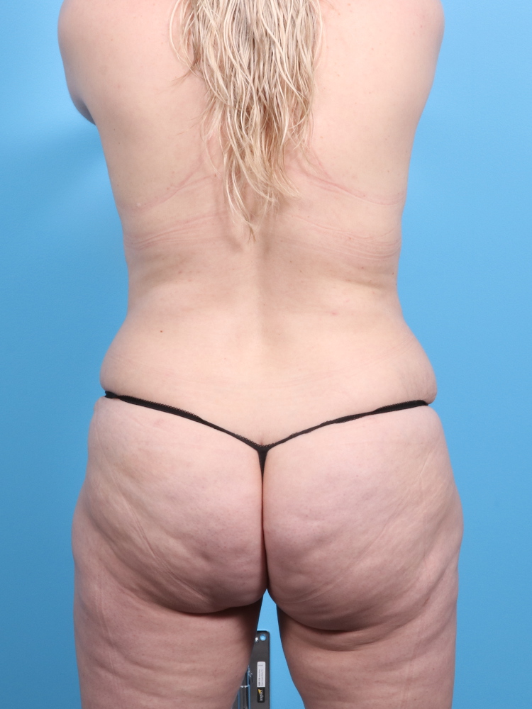 Tummy Tuck Patient Photo - Case 1848 - after view-1