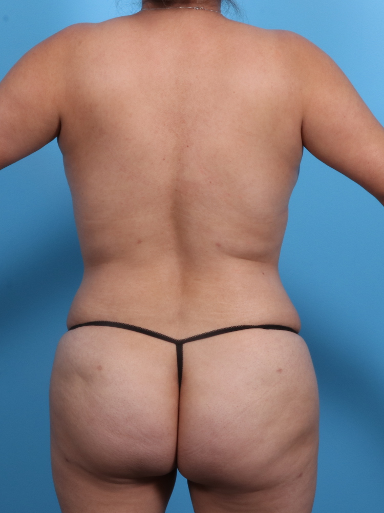 Tummy Tuck Patient Photo - Case 1854 - after view-1