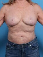 Breast Lift/Reduction w/o Implants - Case 1851 - After