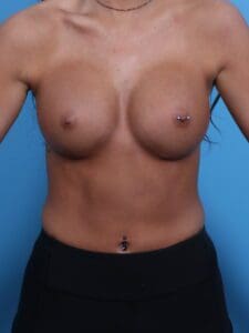 Breast Augmentation - Case 1856 - After