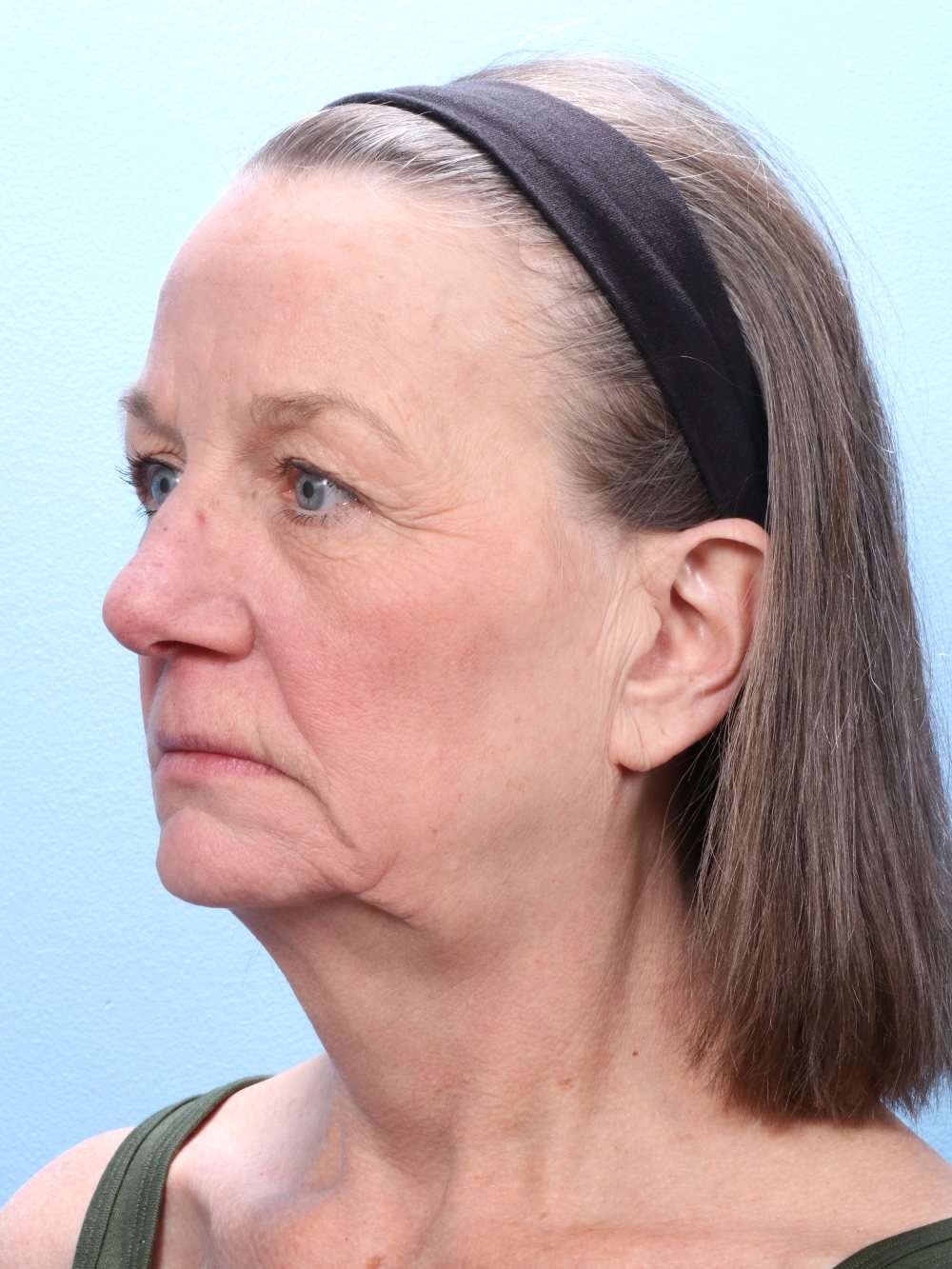 Brow Lift Patient Photo - Case 1857 - before view-1