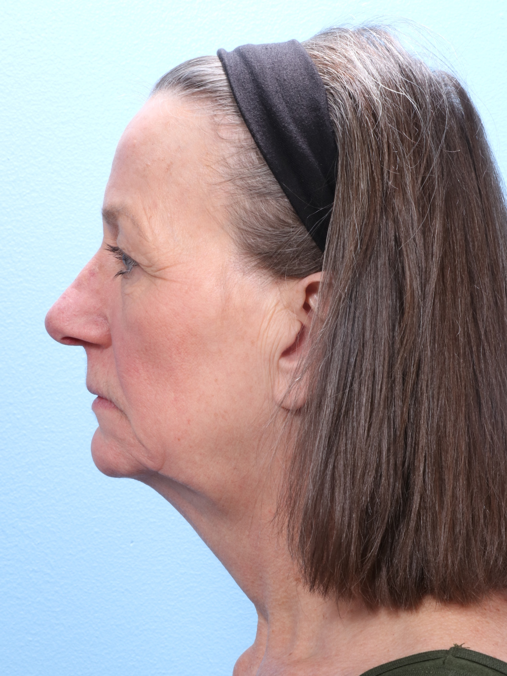 Brow Lift Patient Photo - Case 1857 - before view-2