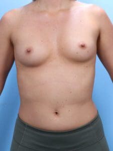 Breast Augmentation - Case 1894 - Before