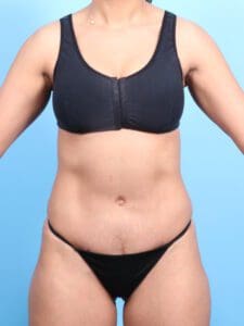 Tummy Tuck - Case 1888 - After