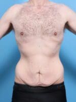 Male Body Lift - Case 1900 - Before