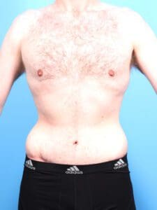 Male Body Lift - Case 1900 - After