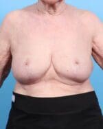 Breast Lift/Reduction w/o Implants - Case 1903 - After