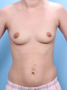 Breast Augmentation - Case 1922 - Before