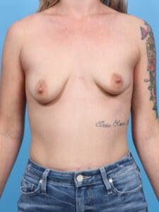 Breast Lift/Reduction with Implants - Case 1916 - Before