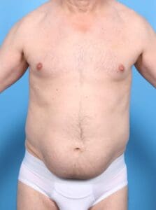 Male Liposuction - Case 16864 - Before