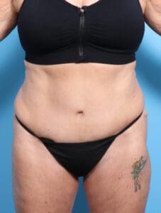 Tummy Tuck - Case 16929 - After