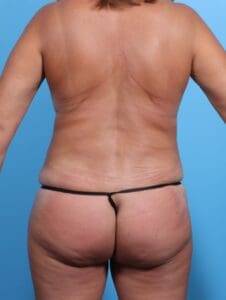 Liposuction - Case 16965 - After