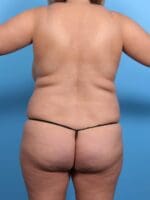 Liposuction - Case 16965 - Before