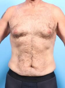 Male Body Lift - Case 17400 - Before