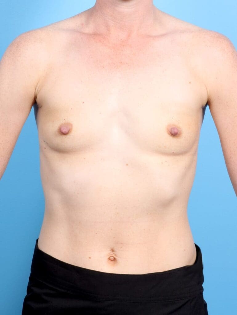 Breast Augmentation - Case 17458 - Before