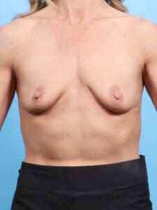 Breast Augmentation - Case 17651 - Before