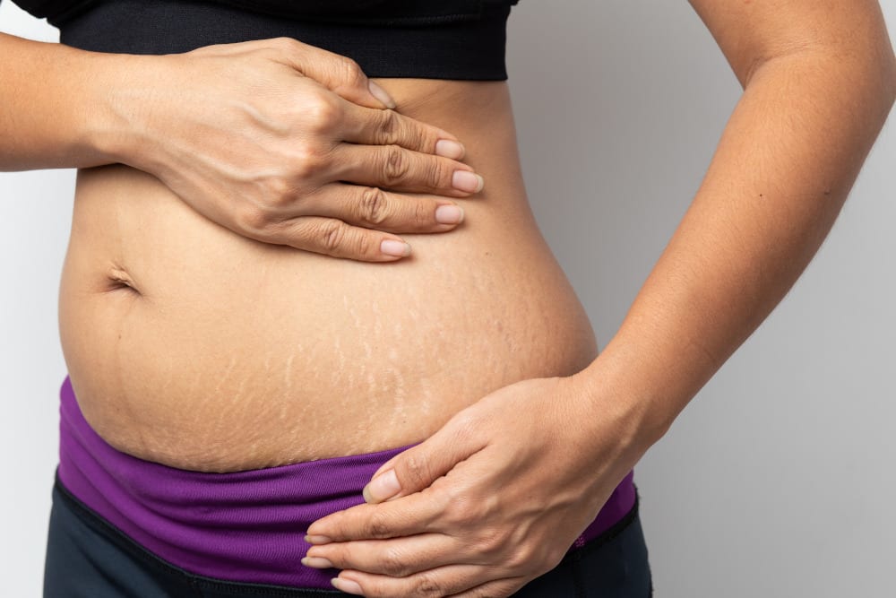 Can a Tummy Tuck Get Rid of Stretch Marks?