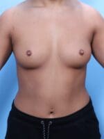Breast Augmentation - Case 19153 - Before