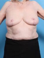 Breast Lift/Reduction w/o Implants - Case 19162 - After