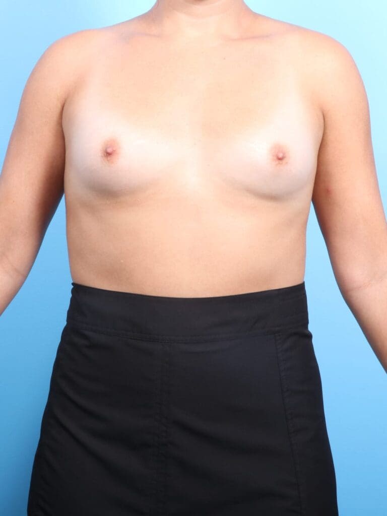 Breast Augmentation - Case 19242 - Before
