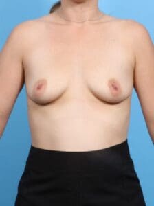 Breast Augmentation - Case 19413 - Before