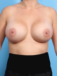 Breast Augmentation - Case 19413 - After