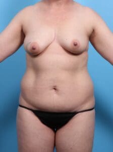 Breast Lift/Reduction with Implants - Case 19505 - Before