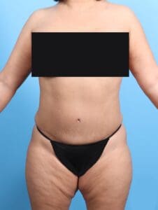 Tummy Tuck - Case 19789 - After
