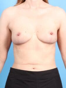 Breast Lift/Reduction w/o Implants - Case 19799 - After