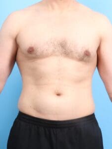 Male Liposuction - Case 19905 - Before