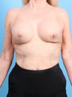 Breast Implant Revision - Case 19973 - After