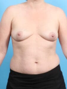 Breast Augmentation - Case 20161 - Before