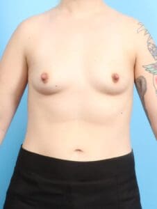 Breast Augmentation - Case 20210 - Before