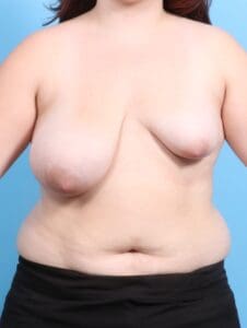 Breast Lift/Reduction w/o Implants - Case 20314 - Before