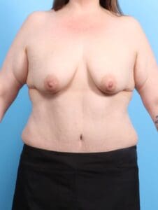 Breast Lift/Reduction with Implants - Case 20322 - Before