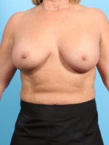 Breast Augmentation - Case 20348 - After
