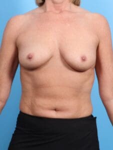 Breast Augmentation - Case 20348 - Before