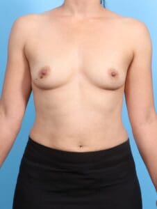 Breast Augmentation - Case 20400 - Before