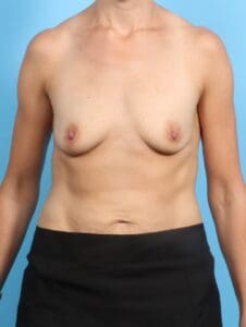 Breast Augmentation - Case 20408 - Before