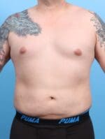 Male Liposuction - Case 20563 - After