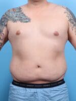 Male Liposuction - Case 20563 - Before