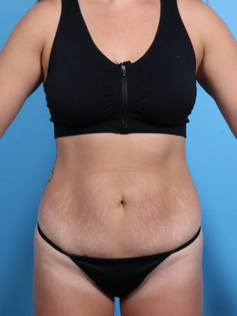 Liposuction - Case 20571 - After