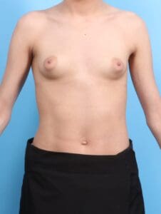 Breast Augmentation - Case 20589 - Before