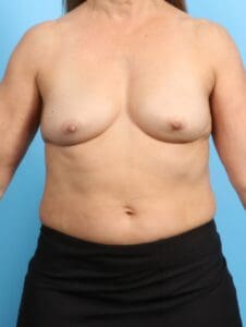 Breast Augmentation - Case 20629 - Before