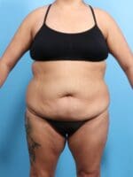 After Weight Loss - Case 20638 - Before