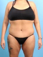 After Weight Loss - Case 20638 - After