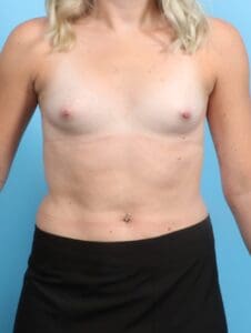 Breast Augmentation - Case 20680 - Before
