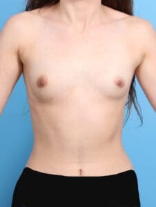 Breast Augmentation - Case 20697 - Before
